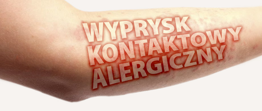 Wyprysk kontaktowy alergiczny